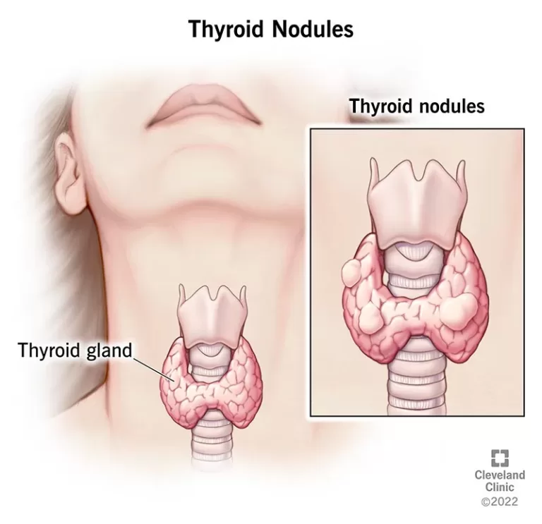 13121-thyroid-nodules-illustration.webp