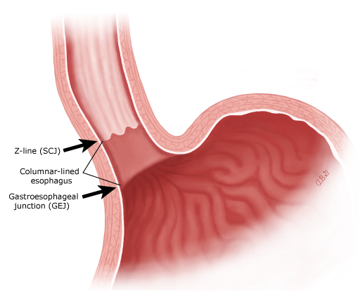 Anatomic landmarks for the diagnosis of Barrett's esophagus