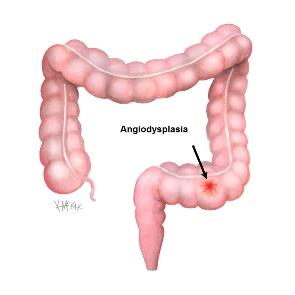 Angiodysplasia