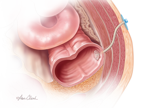 Enteric fistula