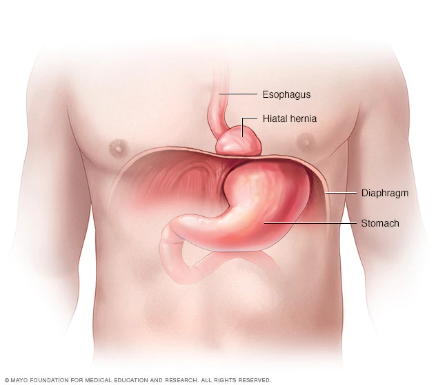 Hiatal hernia