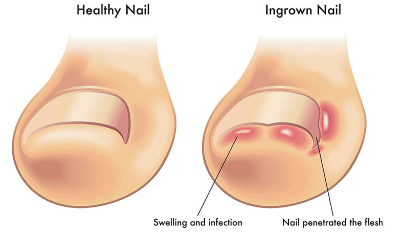 Ingrown toenail