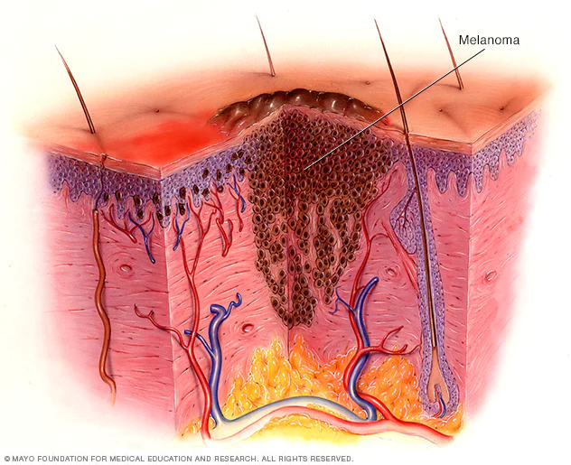 Melanoma skin cancer