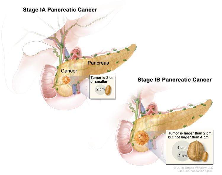 Pancreatic cancer