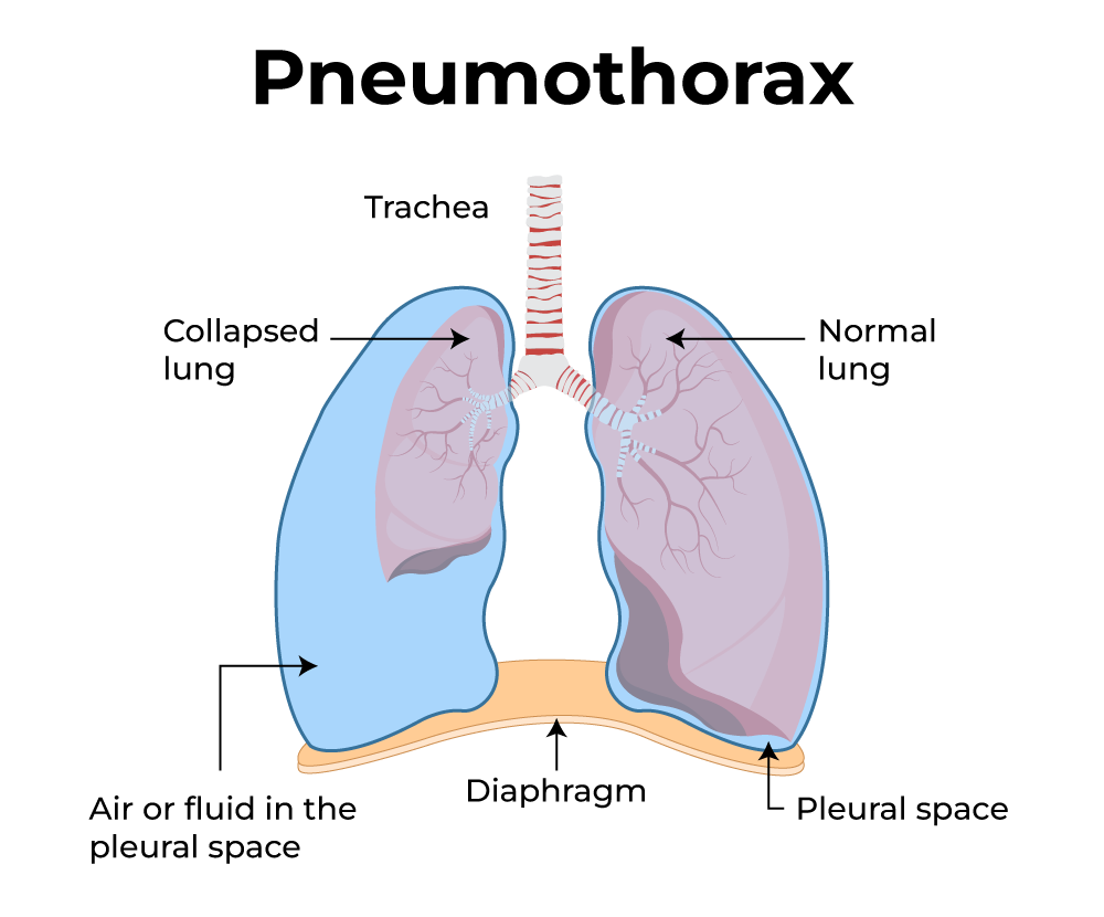 Pneumothorax