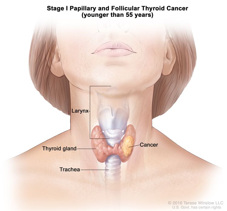 Thyroid cancer