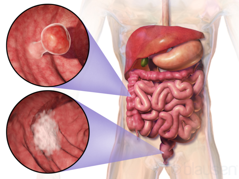 colon-and-rectal-cancer