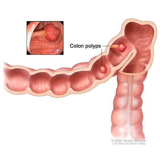 colon_polyps_square