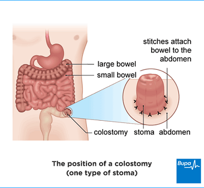 colostomy