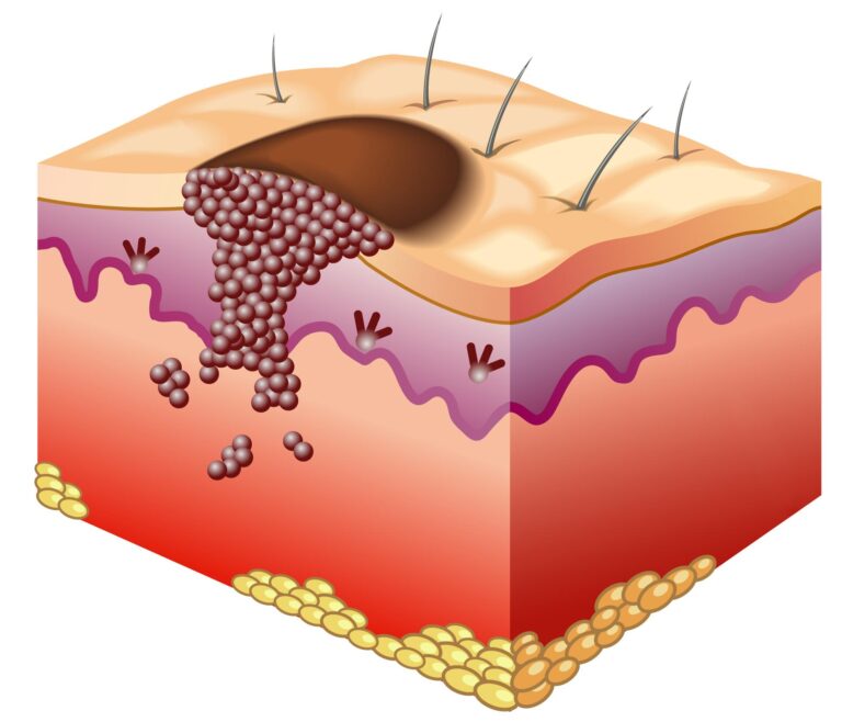 non-melanoma-skin-cancer