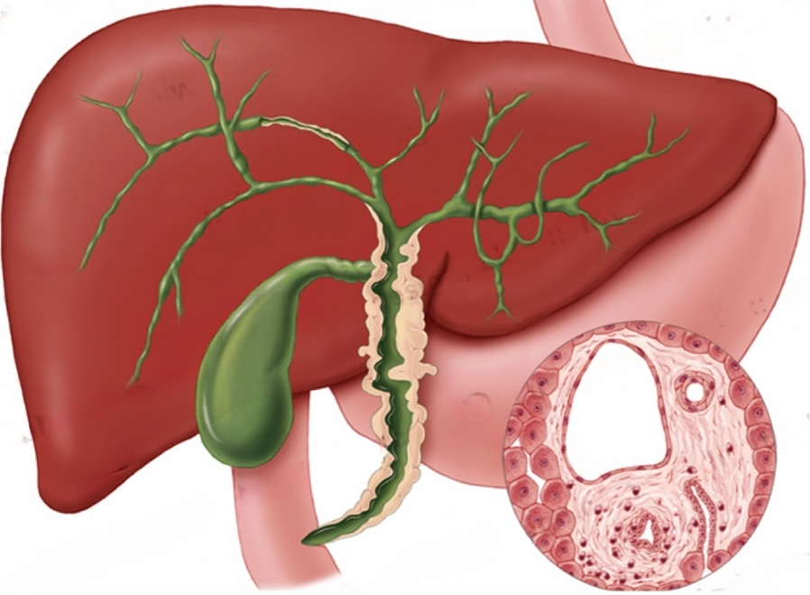 primary biliary cholangitis