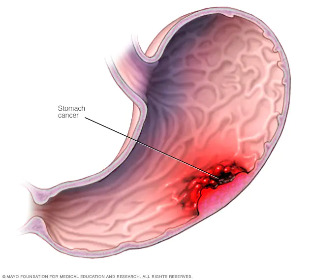 stomach-cancer