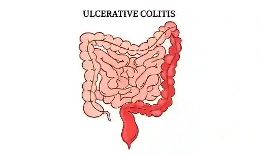 ulcerative colitis