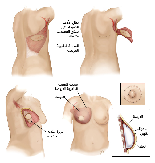 إعادة بناء الثدي باستخدام السديلة الظهرية