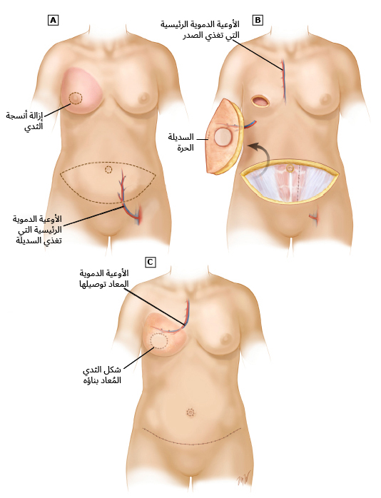 إعادة بناء الثدي باستخدام سديلة الثاقوب الشرسوفي السفلي العميق (DIEP)