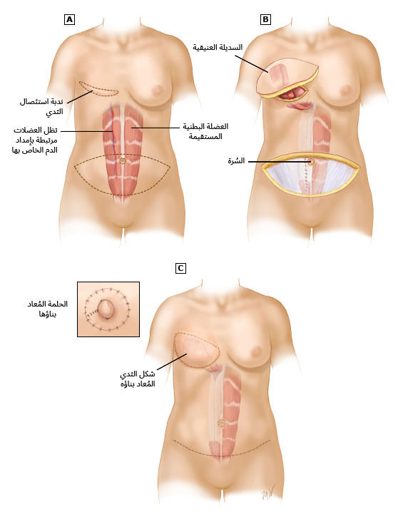إعادة بناء الثدي باستخدام سديلة العضلة الجلدية البطنية المستقيمة المستعرضة (TRAM) العُنيقية