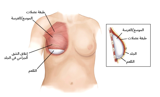 إعادة بناء الثدي باستخدام غرسة