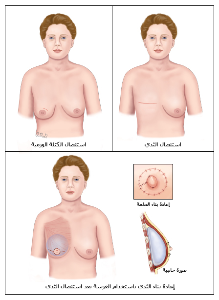 استئصال الثدي واستئصال الكتلة الورمية لعلاج سرطان الثدي