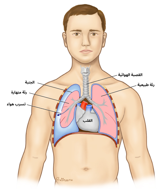 الاسترواح الصدري (الرئة المنهارة)