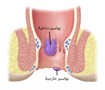 البواسير