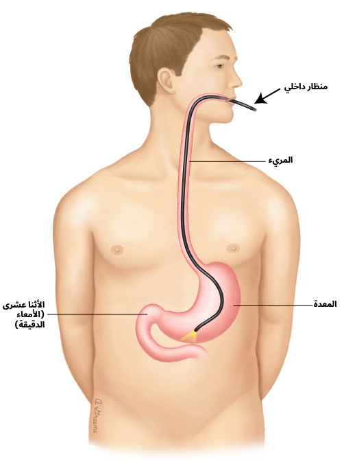 أثناء التنظير الداخلي العلوي، تستلقي ويضع الطبيب أنبوبًا رفيعًا مزودًا بكاميرا وضوء في نهايته (يسمى المنظار الداخلي) في فمك ويدفعه ليصل إلى المريء والمعدة والاثنا عشر (الجزء الأول من الأمعاء الدقيقة). ترسل الكاميرا الصور من داخل جسمك إلى شاشة تلفزيون. وبهذا يمكن لطبيبك أن يرى ما بداخل المريء والمعدة والاثنا عشر.