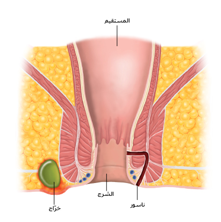 الخراج والناسور الشرجي