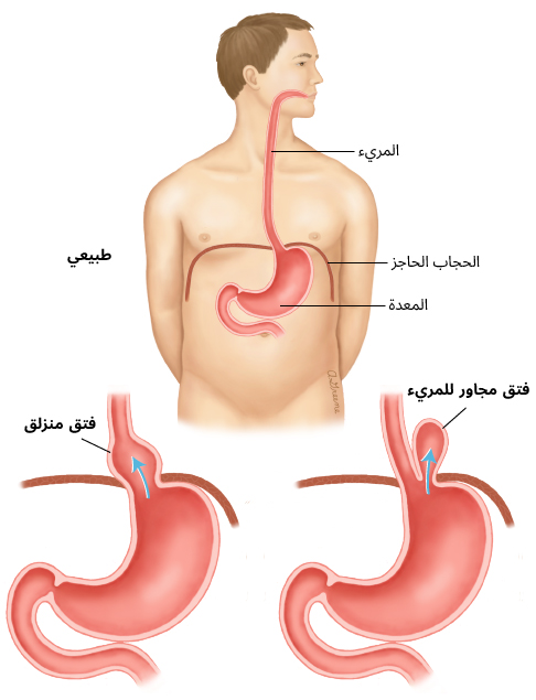 الفتق الحجابي