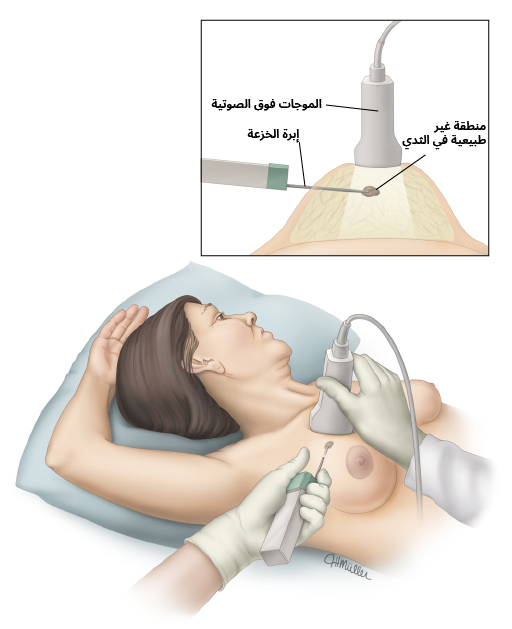 خزعة الثدي الموجَّهة بالموجات فوق الصوتية