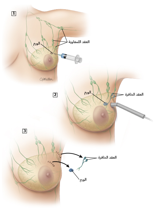 خزعة العقدة الخافرة للكشف عن سرطان الثدي