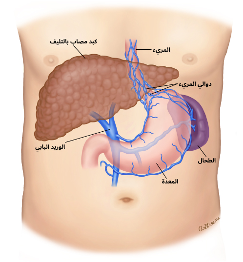 دوالي المريء