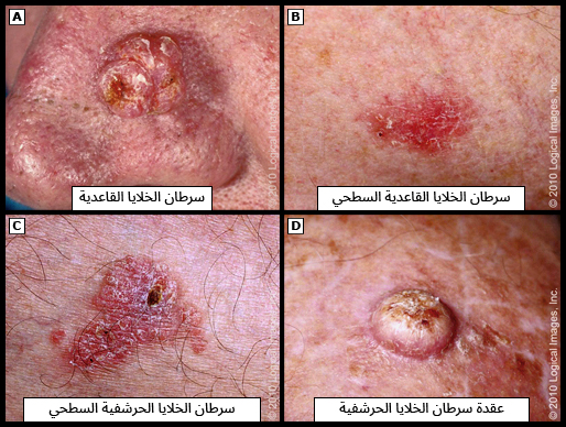 سرطان الجلد غير القتامي
