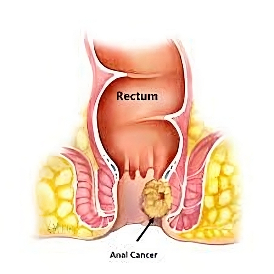 سرطان_الشرج_(Anal_cancer)