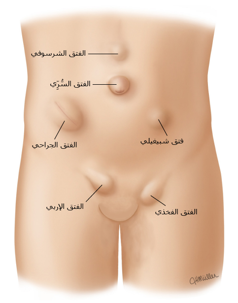 فتوق جدار البطن
