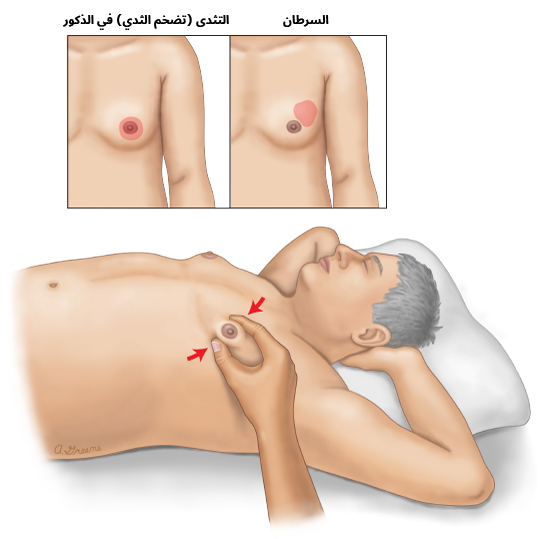 كيفية قيام الأطباء بفحص أنسجة الثدي عند الرجال