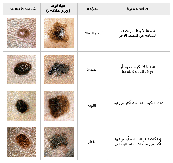 هل هذه شامة أم ميلانوما (ورم ملاني)؟

