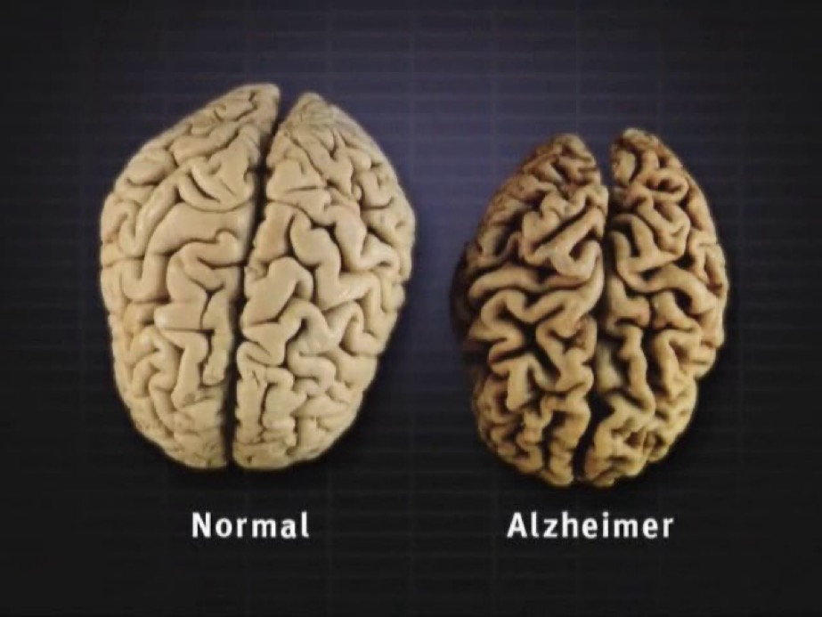 Alzheimer Brain