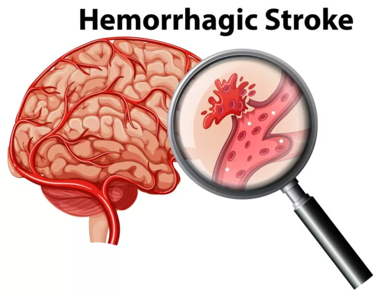 hemorrhagic stroke