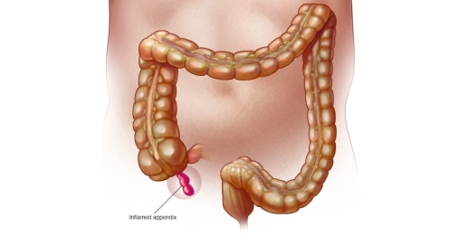 acute appendicitis