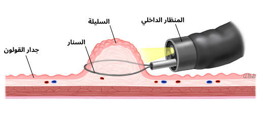 إزالة سليلة القولون
