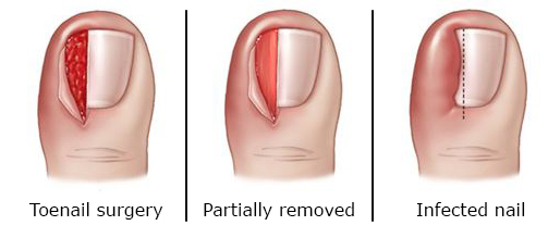 Possible treatment options for an ingrown toenail.

