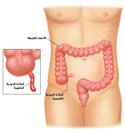 التهاب الزائدة الدودية